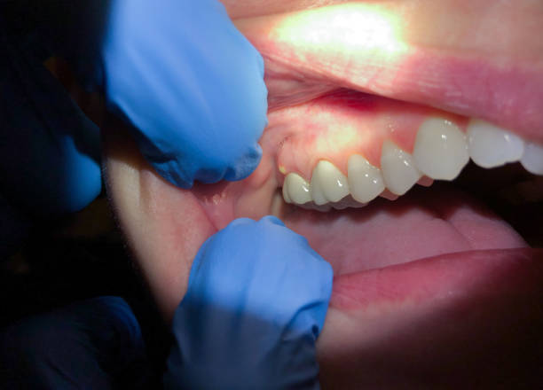Best Emergency Dentist for Lost Fillings or Crowns in El Dorado, AR